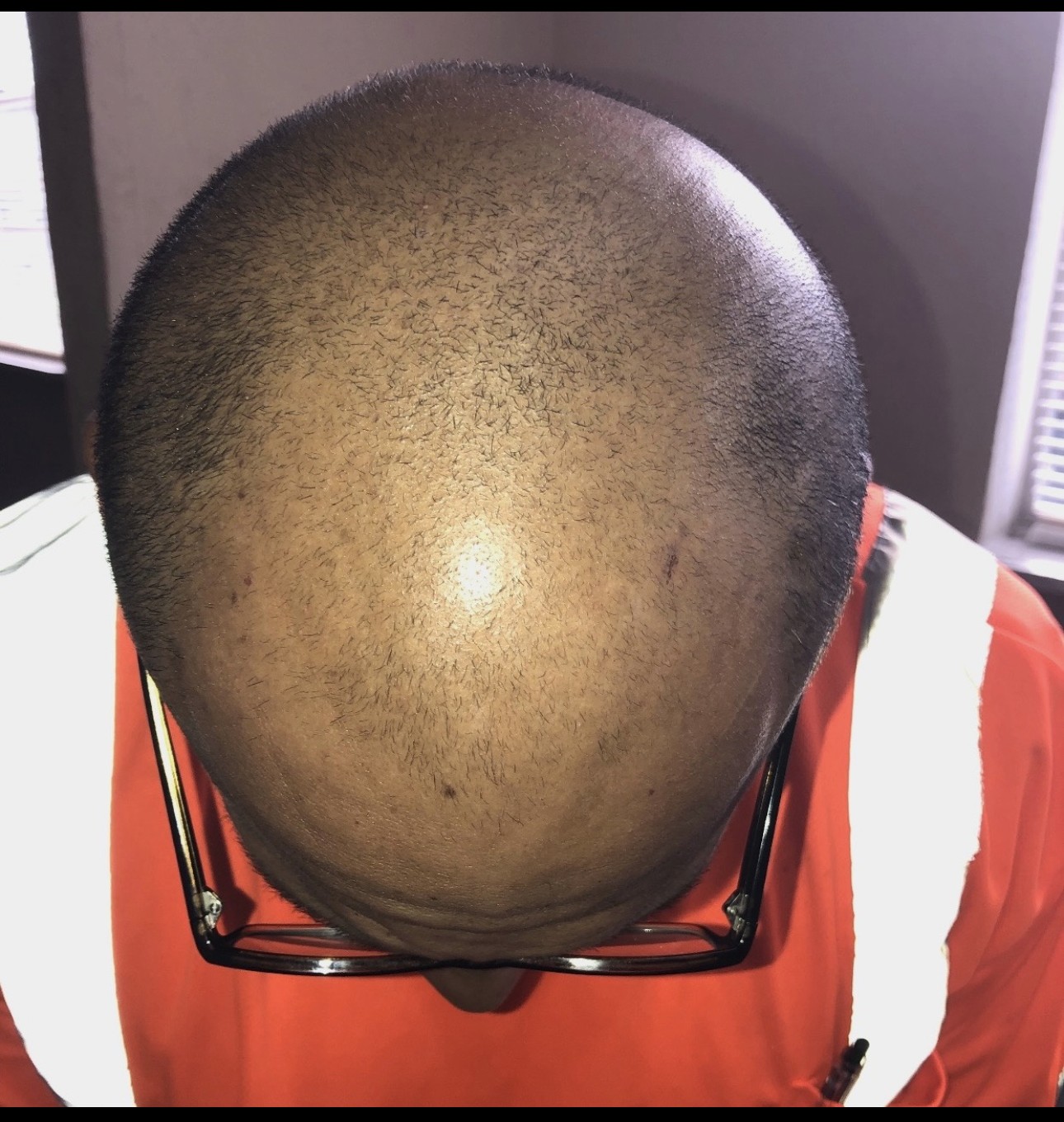 After — hair regrowth