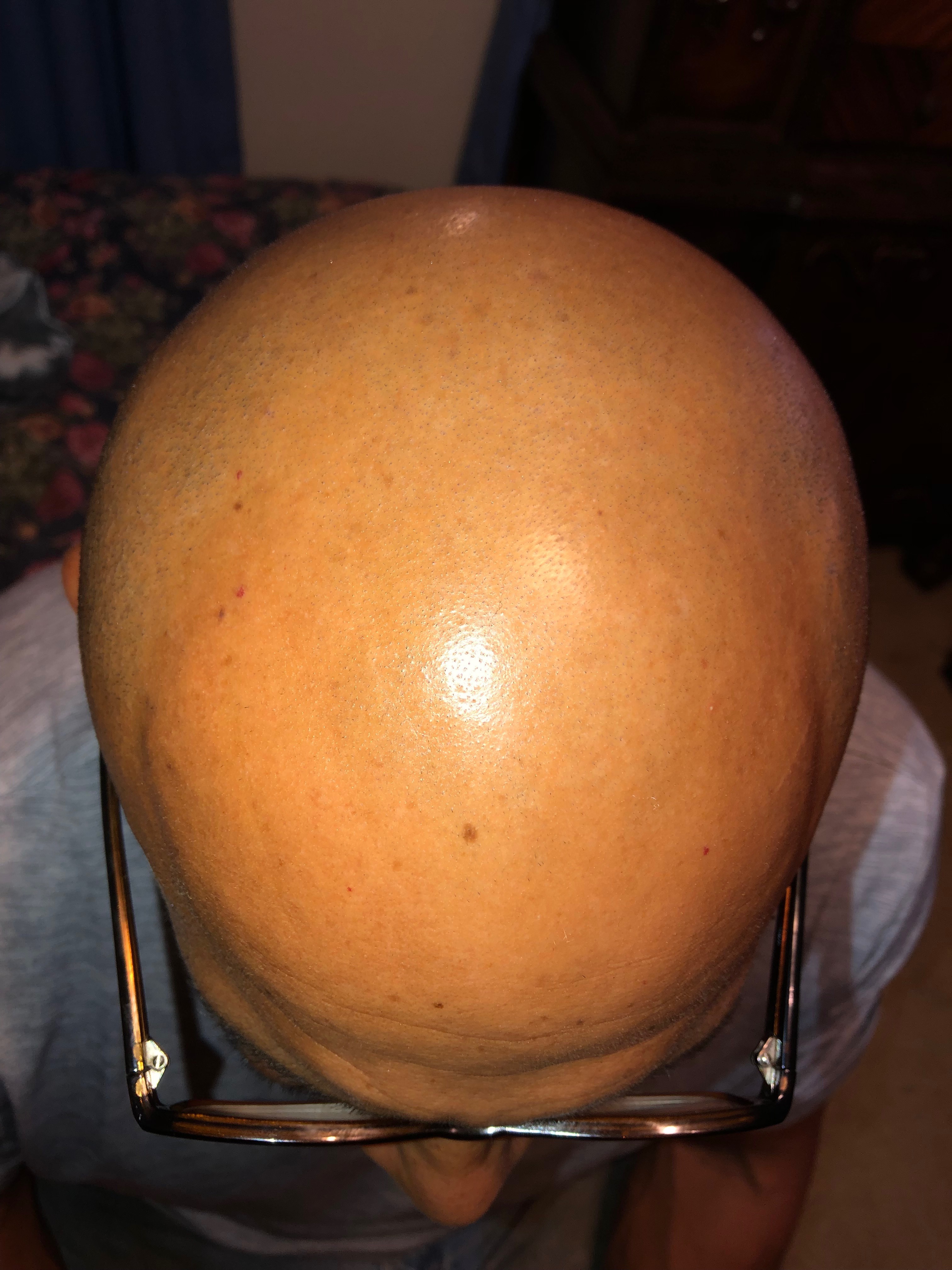 Before — hair loss